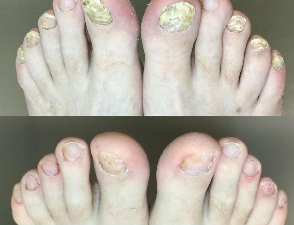 Before and after treatments, creams for change fungus