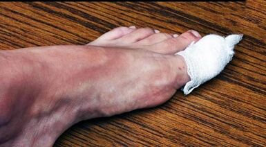 Compresses to treat fungus on the thumb leg