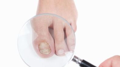 How to treat a fungus on your leg thumb