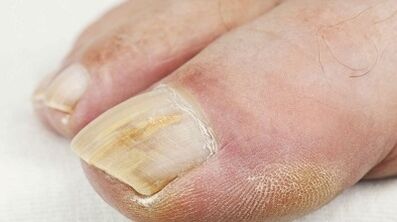 Reasons Appearance Fungi on the thumb leg