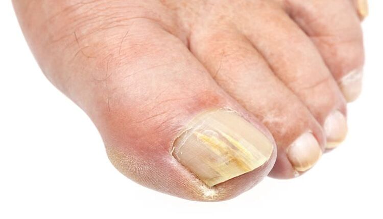 an external change on the nail is a sign of a fungal infection