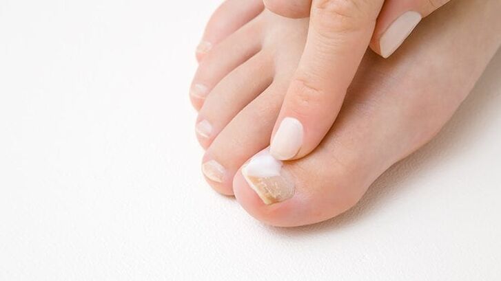 a type of toenail fungus