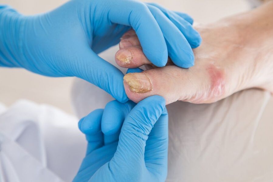 nail plates affected by fungi