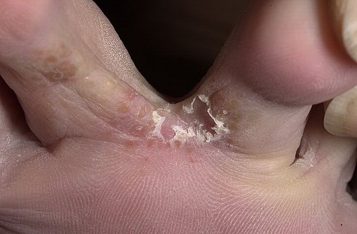 Cracked skin between the toes is a symptom of intertriginous fungi