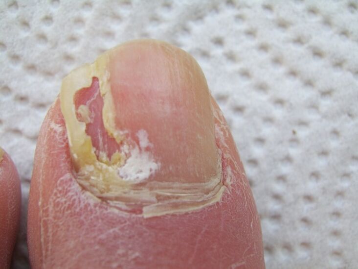 In onychomycosis, the nail plate is deformed