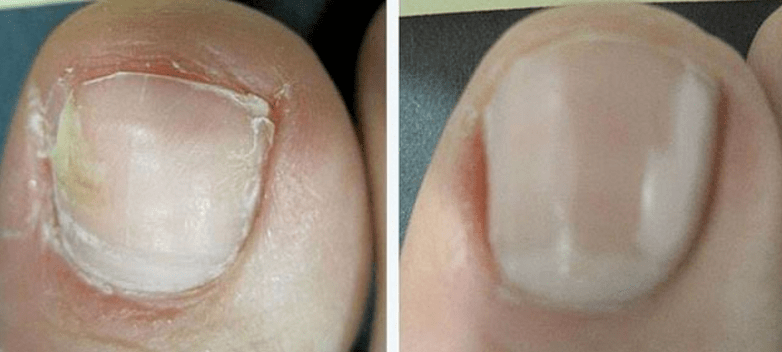 Nails before and after fungal treatment