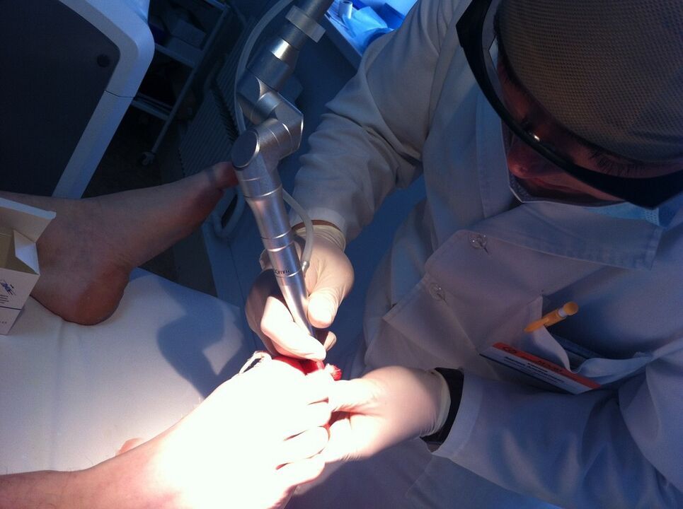 Mikoze's laser treatment