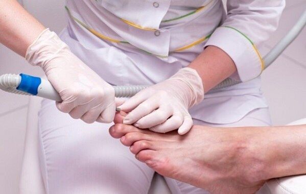 Toenail fungus treatment procedure
